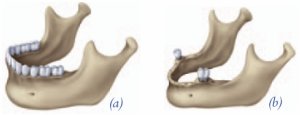 http://akronoralsurgerygroup.com/bone_loss.jpeg