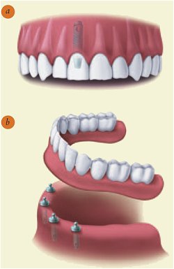 http://akronoralsurgerygroup.com/implants.jpeg